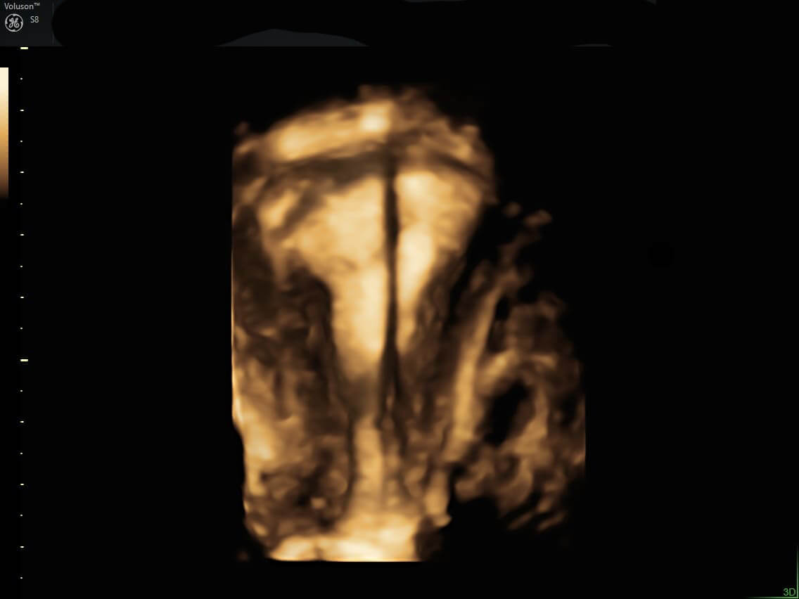 transvaginal diu
